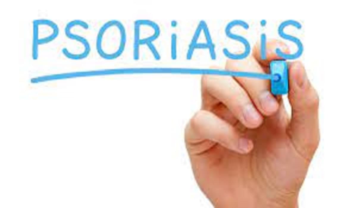 An expert debunks some prevalent psoriasis beliefs