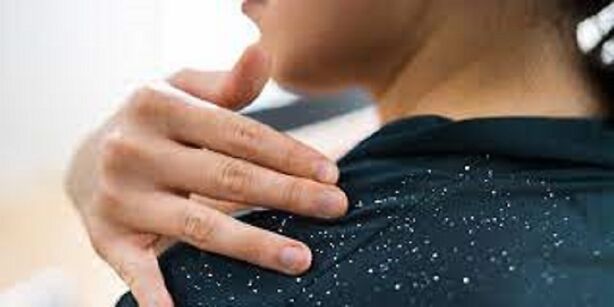 Remedies for Monsoon-Induced Dandruff